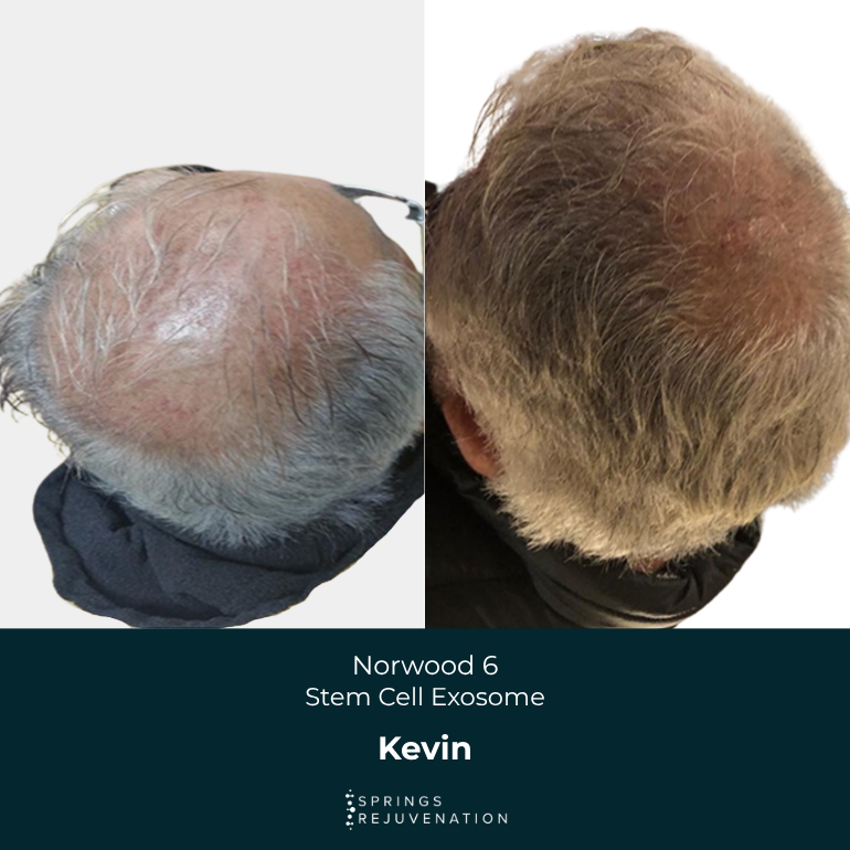 Kevin - Before & After